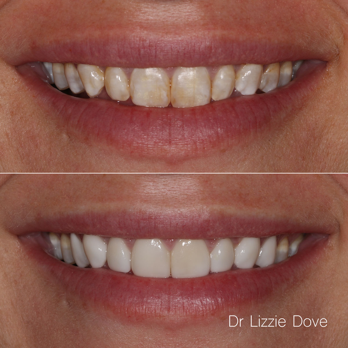 Before — developmental intrinsic discolouration