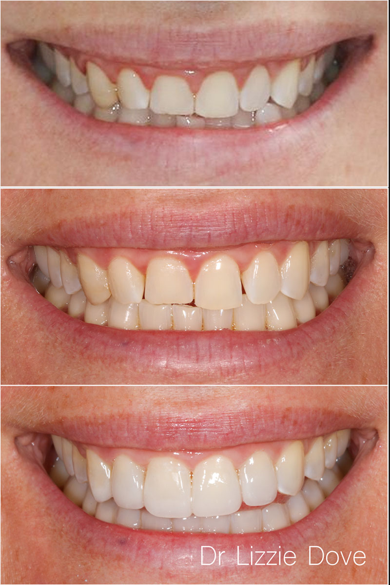 Before — edge-to-edge bite with severe wear